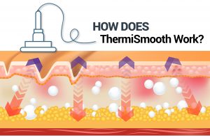 How Does ThermiSmooth Work