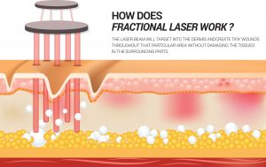 How does Fractional Laser work