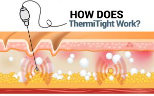 How does ThermiTight work?