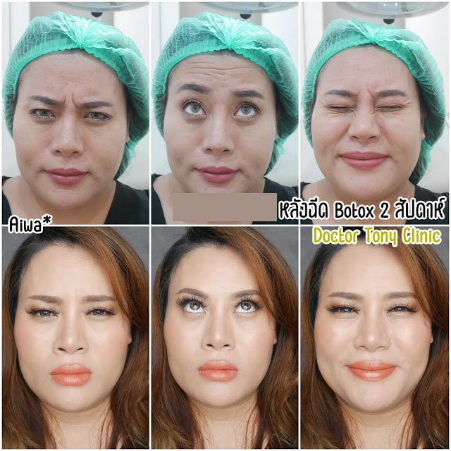 before-After-botox